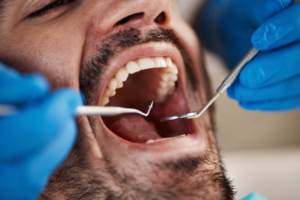 Best Emergency Wisdom Tooth Extraction in Forsyth, IL